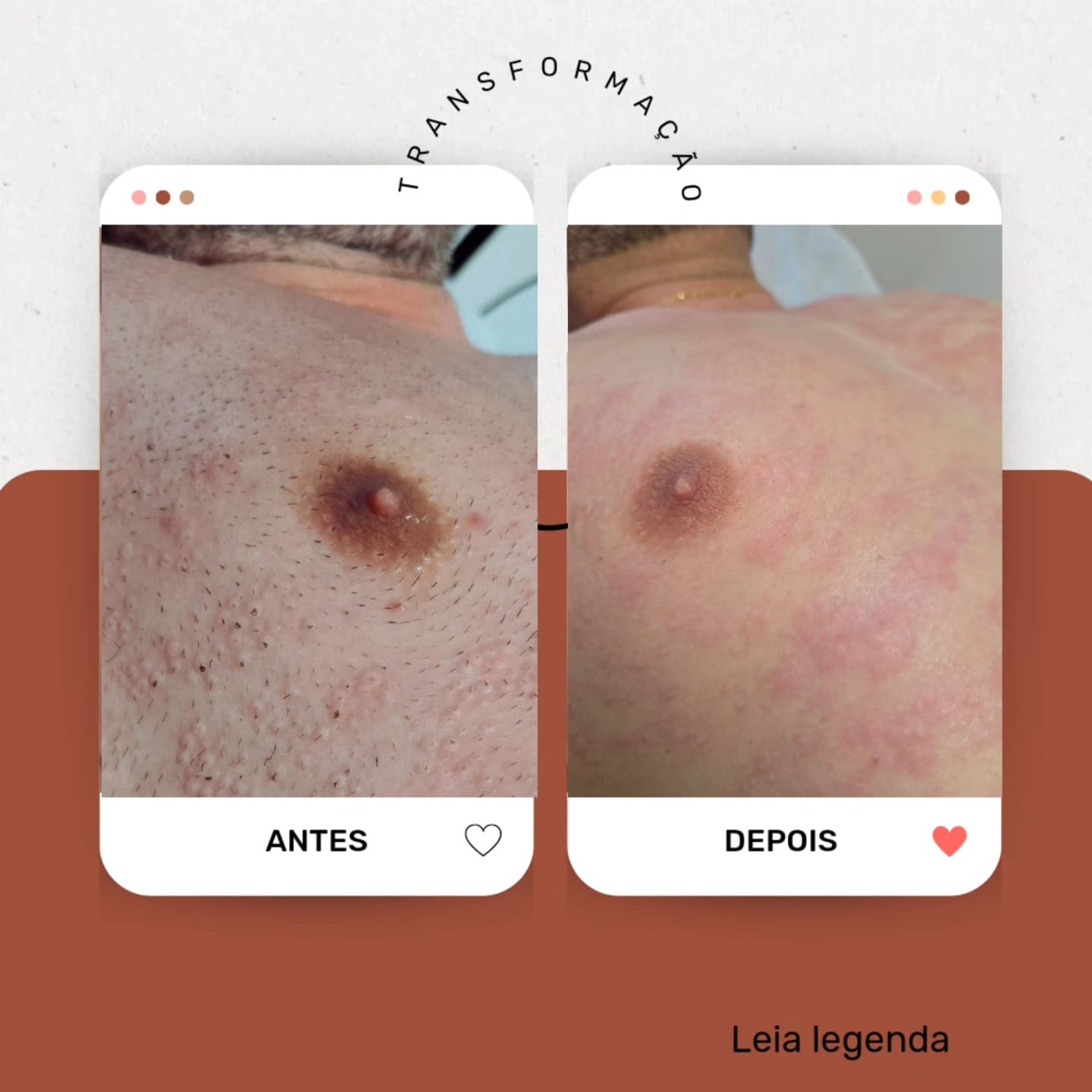 Resultado depilação a laser